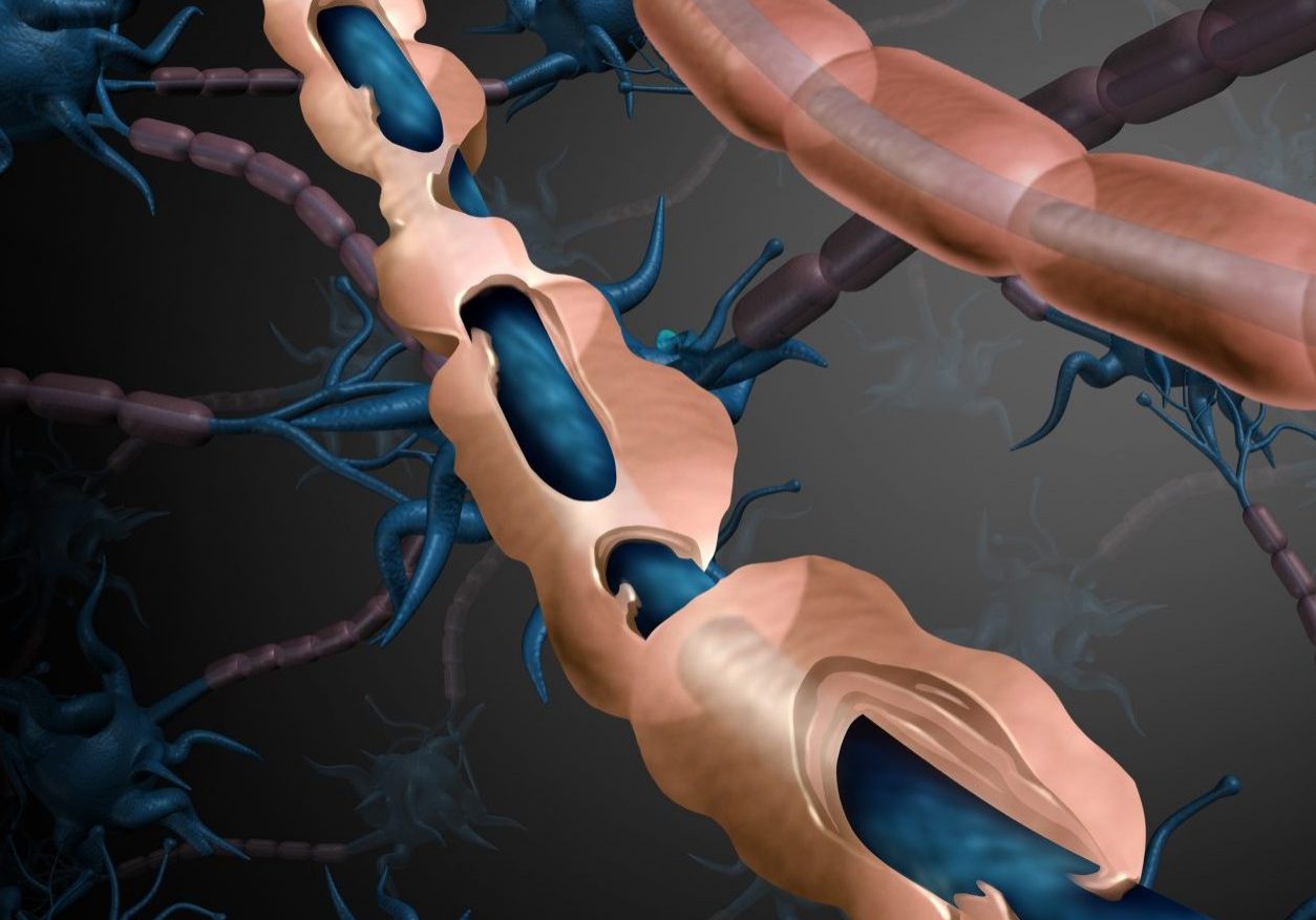 Multiple sclerosis nerve disorder and damaged myelin or MS autoimmune disease with healthy nerve with exposed fibre with scarrred cell sheath loss with 3D illustration elements.